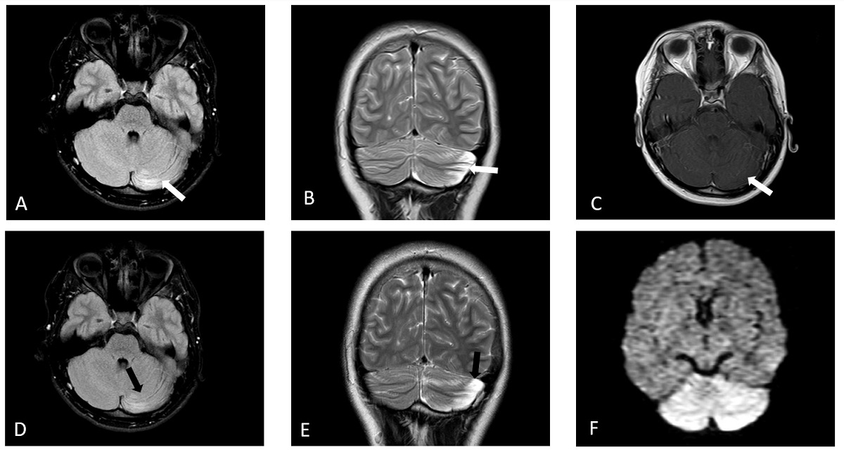 Figura 2. Cerebelitis aguda. Evolución de la afectación cerebelosa en el caso 1. Control a los 8 meses: (A) Axial FLAIR. (B) Coronal FSE T2. (C) Axial eco de gradiente T1 con contraste. Secuela de cerebelitis con encefalomacia de hemisferio cerebeloso izquierdo que presenta ampliación del espacio subaracnoideo y gliosis sin realce tras contraste (flechas blancas). Control a los 4 años. (D) Axial FLAIR. (E) Coronal FSE T2. Leve aumento de la encefalomalacia de hemisferio cerebeloso izquierdo con gliosis y mayor ampliación del espacio subaracnoideo (flechas negras). Caso 2: (F). Difusión. RM difusión, proyección axial. Hiperintensidad difusa del cerebelo sólo en la fase aguda de la cerebelitis.